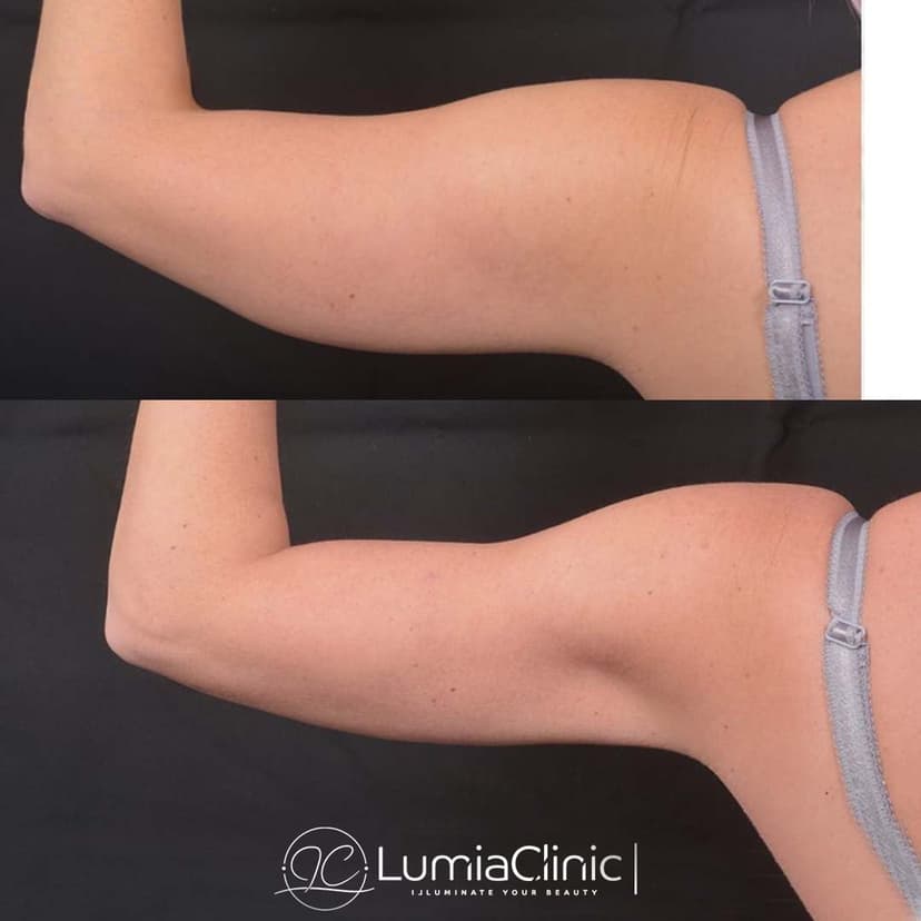 Arm Lifting before and after 1