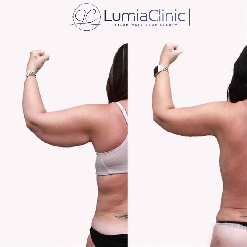 Arm Lifting before and after 2