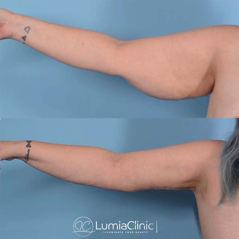 Arm Lifting before and after 3