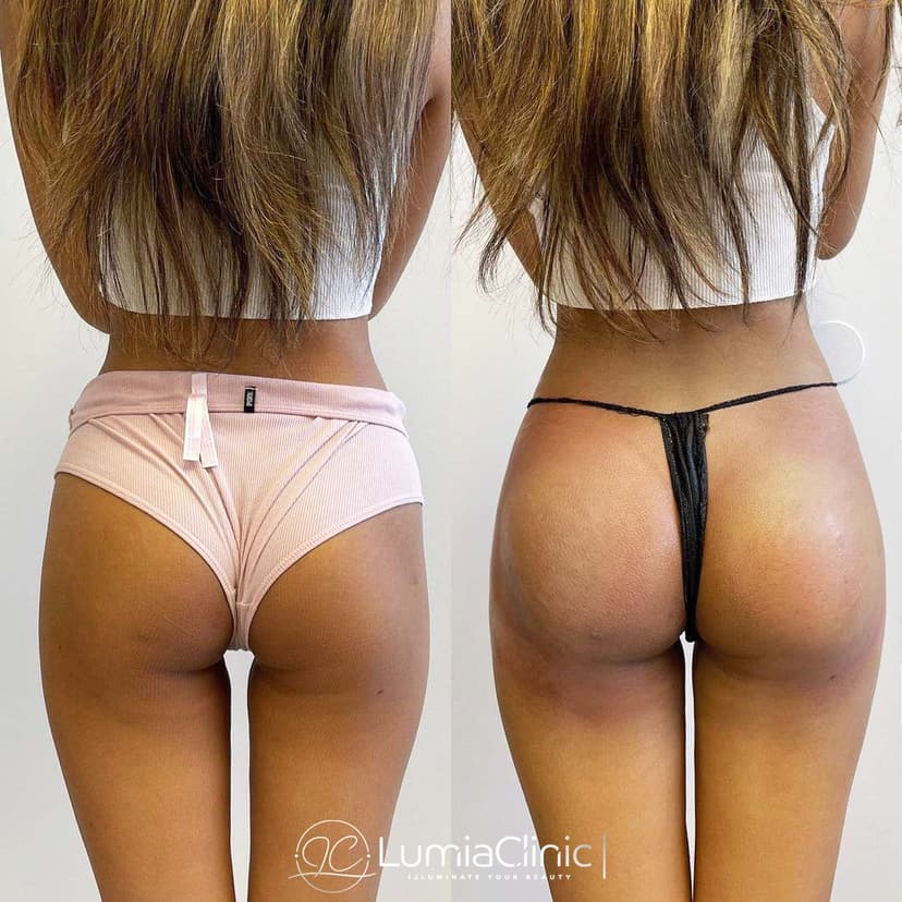 Brazilian Butt before and after 3