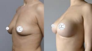 Breast Surgery before and after 3