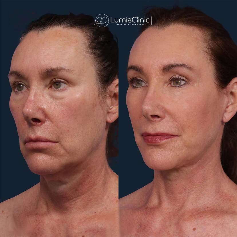 Face Lifting before and after 1
