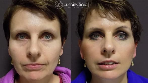 Face Lifting before and after 2