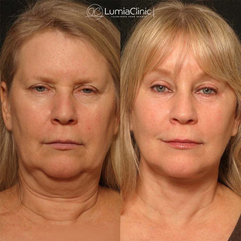 Face Lifting before and after 3
