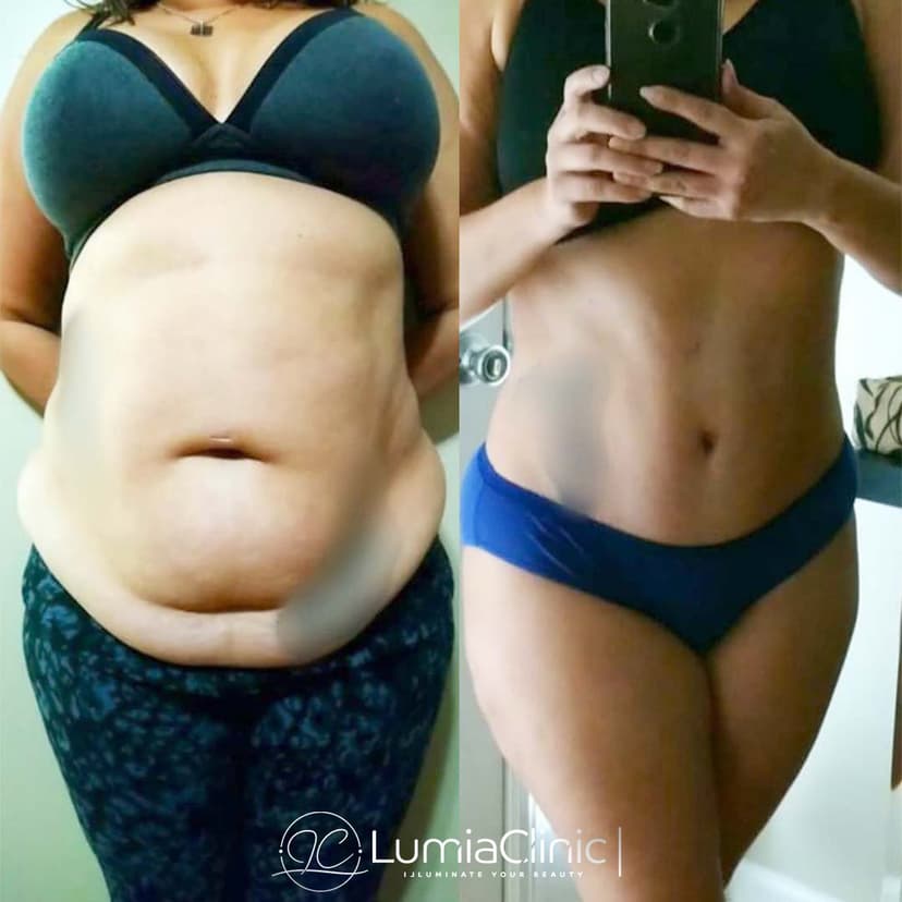 Liposuction before and after 1
