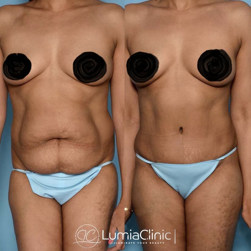 Liposuction before and after 2