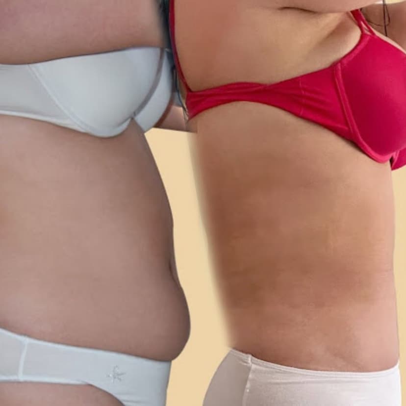 Liposuction before and after 3