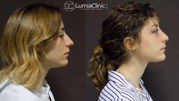 Rhinoplasty before and after 1