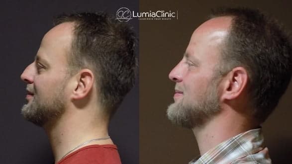 Rhinoplasty before and after 2