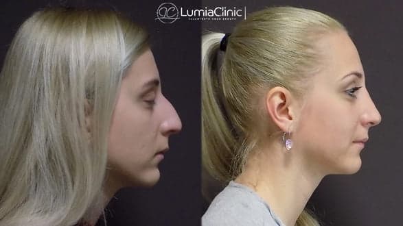 Rhinoplasty before and after 3