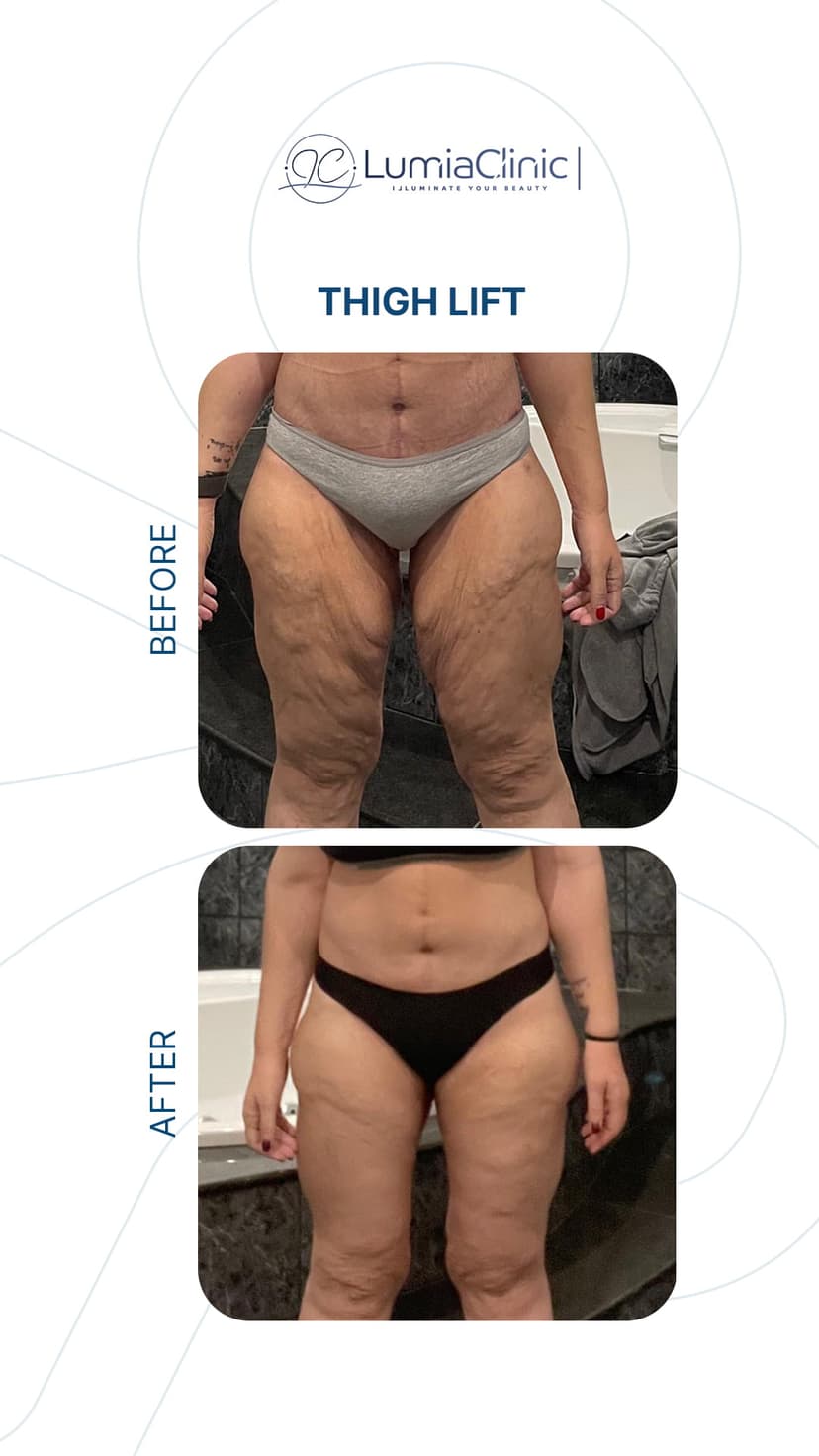 Thigh Lift before and after 1