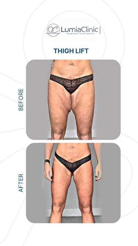 Thigh Lift before and after 2