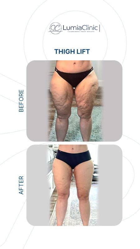 Thigh Lift before and after 3