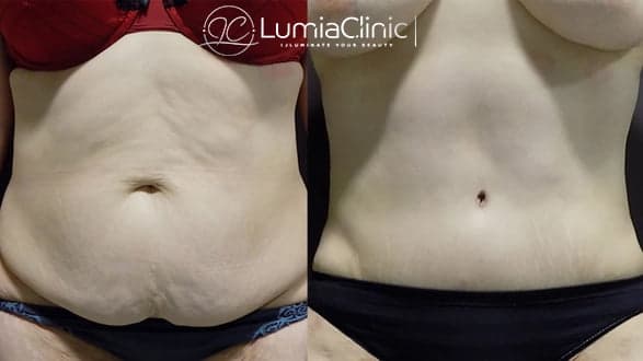 Tummy Tuck before and after 1