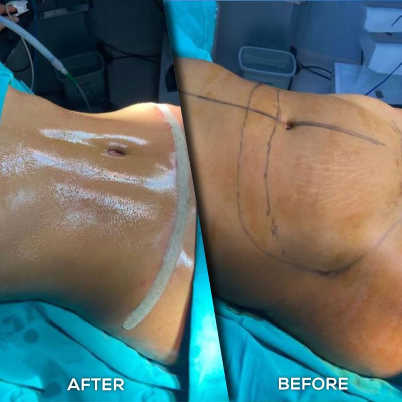 Tummy Tuck before and after 2