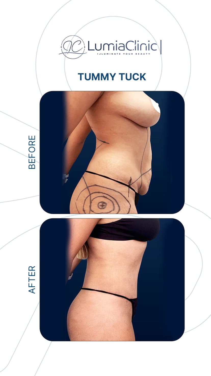 Tummy Tuck before and after 3