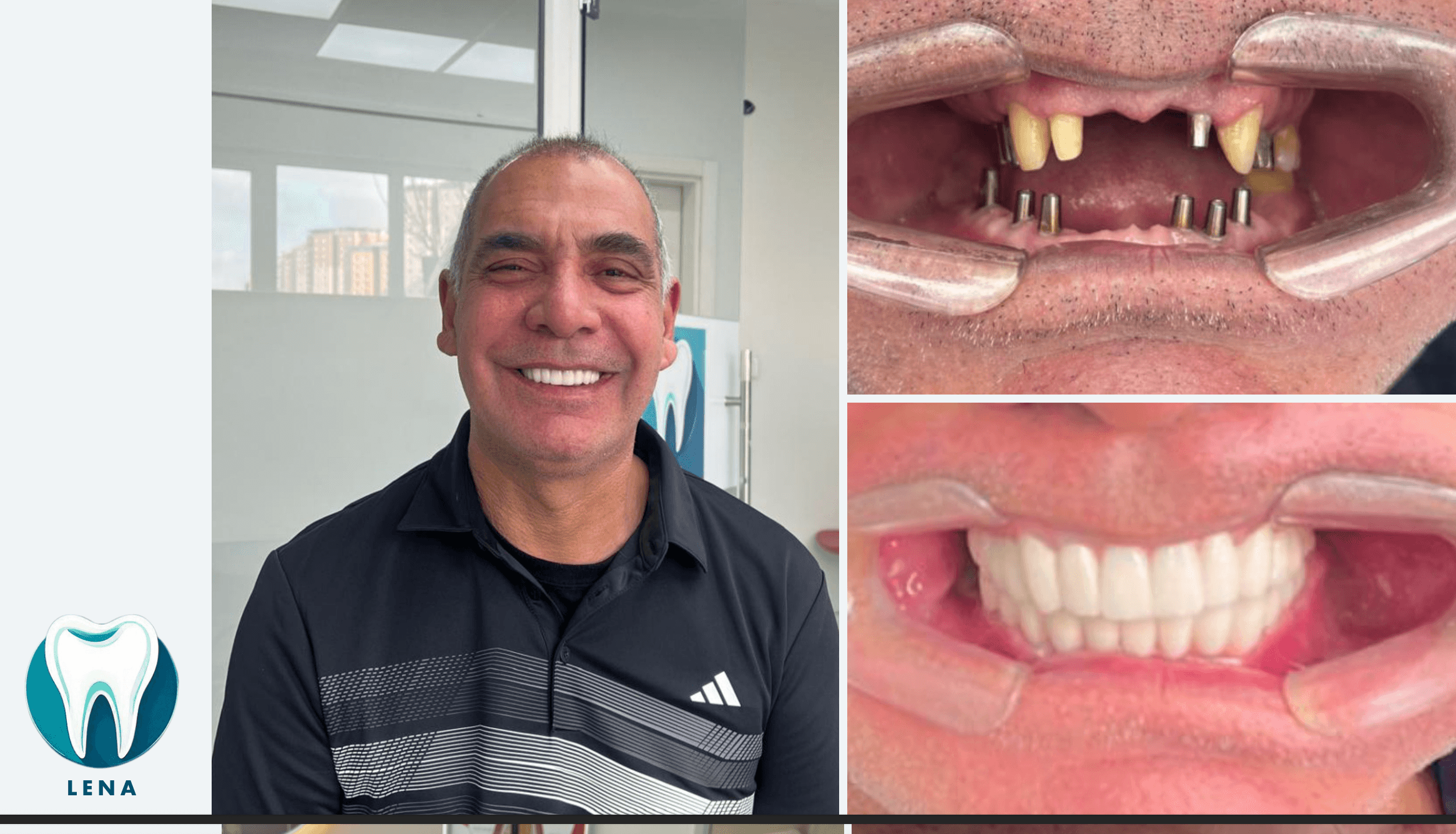 Dental before and after 2
