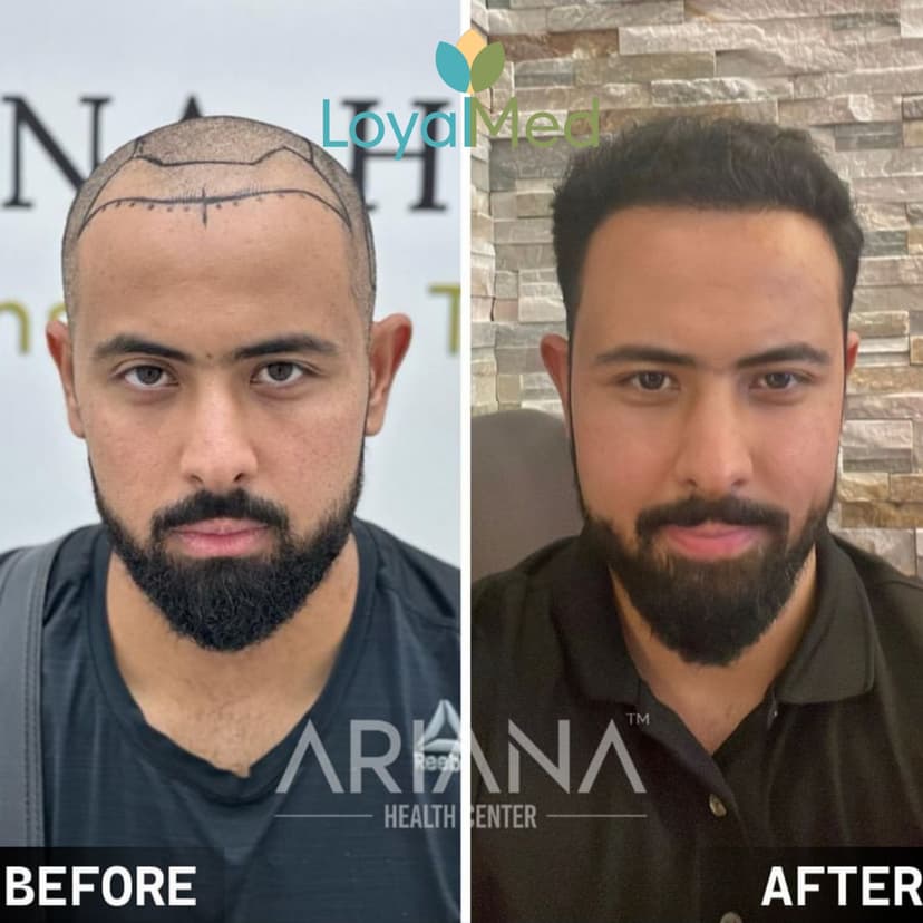 Hair transplant before and after 1