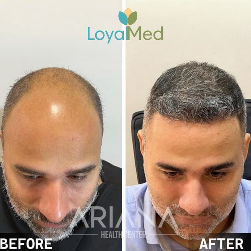 Hair transplant before and after 2