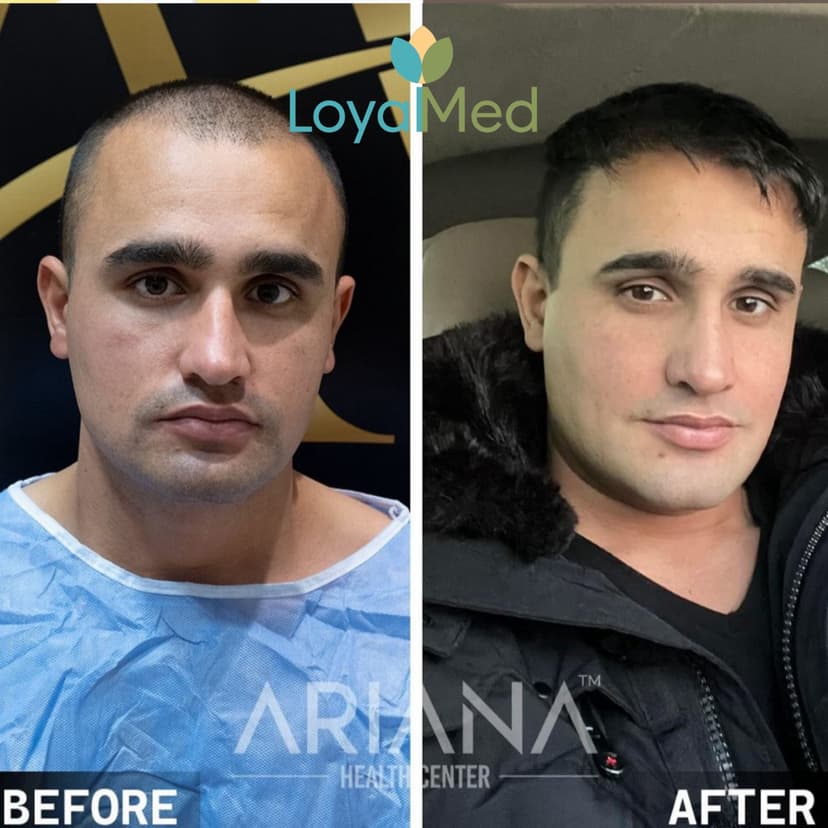 Hair transplant before and after 3