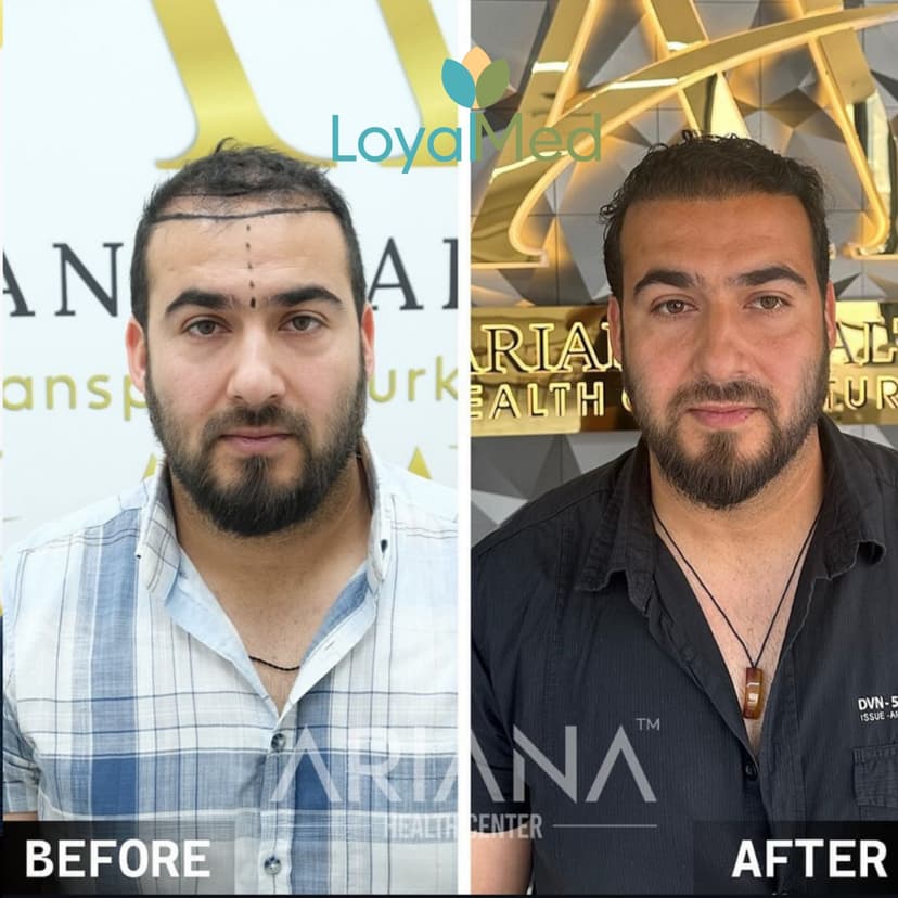 Hair transplant before and after 4