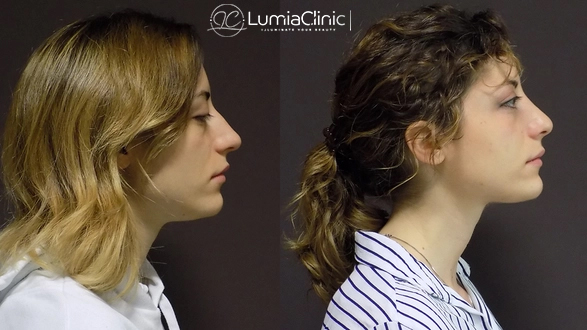 تجميل الأنف