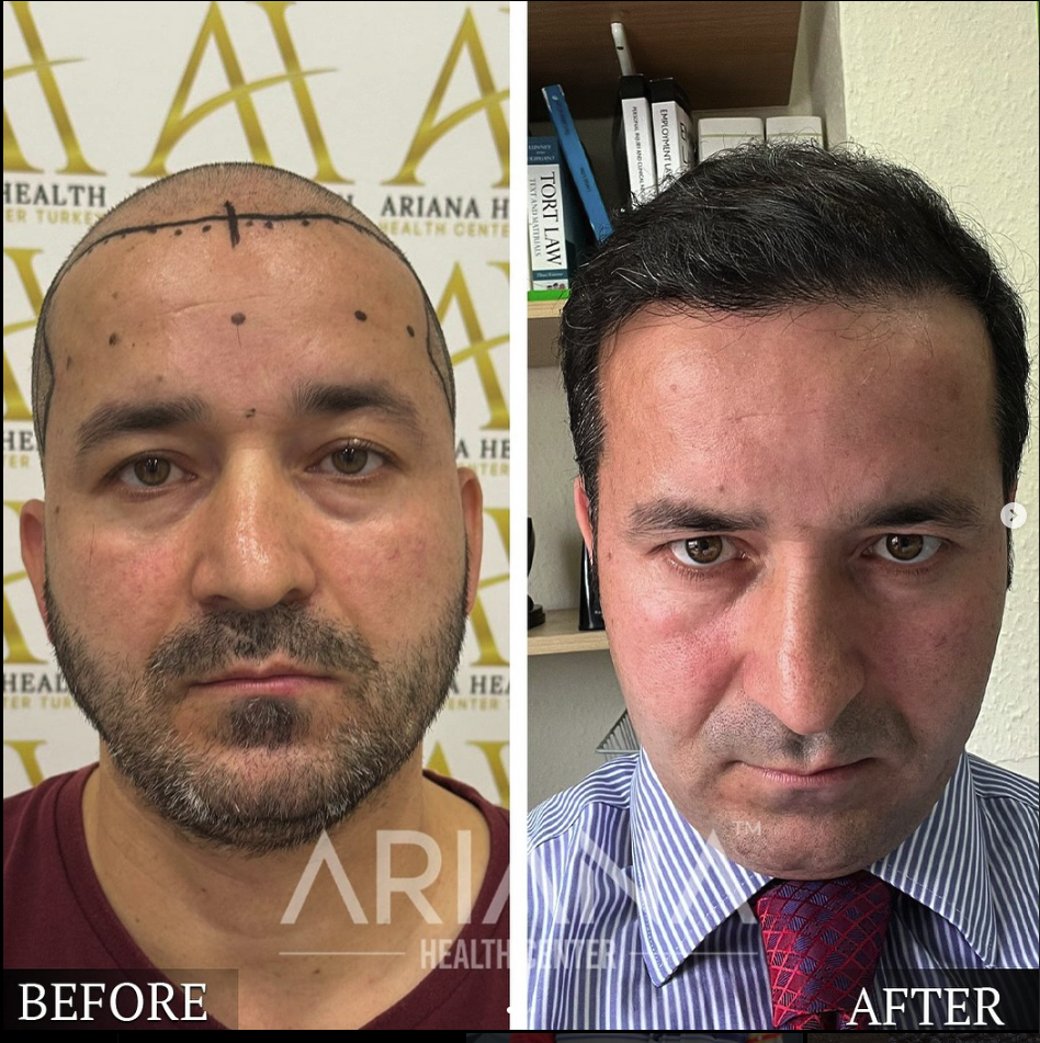 باقة زراعة الشعر